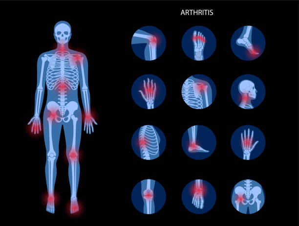 Arthritis Sets 2 Pain in male human body. Man skeleton silhouette. Spine, knee, other joint icons. Arthritis, inflammation, fracture, bone structure and cartilage concept. Medical poster. Flat xray vector illustration human skeleton stock illustrations