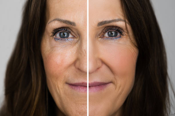 istock Anti Rejuvenation Wrinkles Lift Before 1296688747