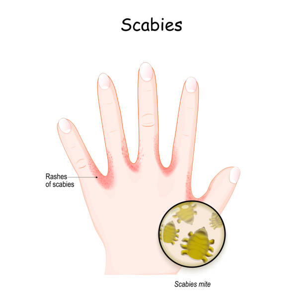 Scabies mite. Human's hand. skin with Rashes. Scabies mite. Human's hand. skin with Rashes. seven-year itch is a contagious skin infestation by the mite Sarcoptes scabiei. Close-up of Scabies mite. Vector illustration sarcoptes scabiei stock illustrations