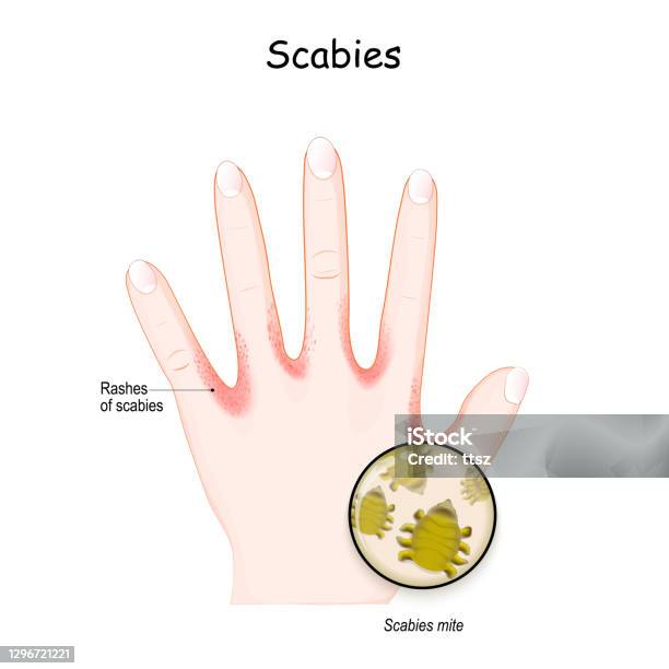 Scabies Rch Scabies Mite Humans Hand Skin With Rashes Stock Illustration - Download ...