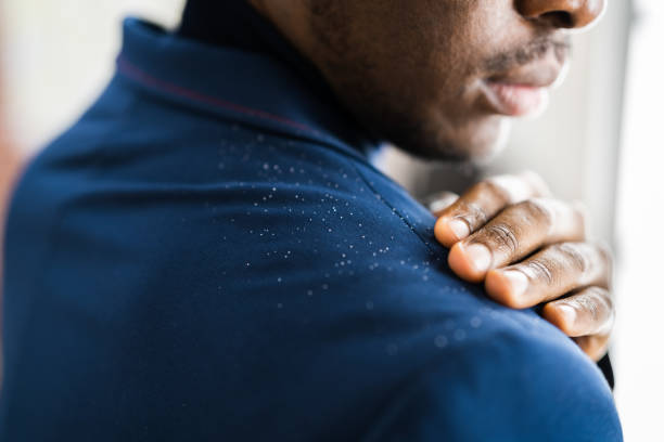 Man Brushing Dandruff From Dirty Suit. Itchy Head Man Brushing Dandruff From Dirty Suit. Itchy Head And Hair dandruff stock pictures, royalty-free photos & images