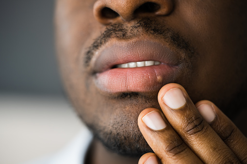 African American Mouth Lip Skin Herpes photo