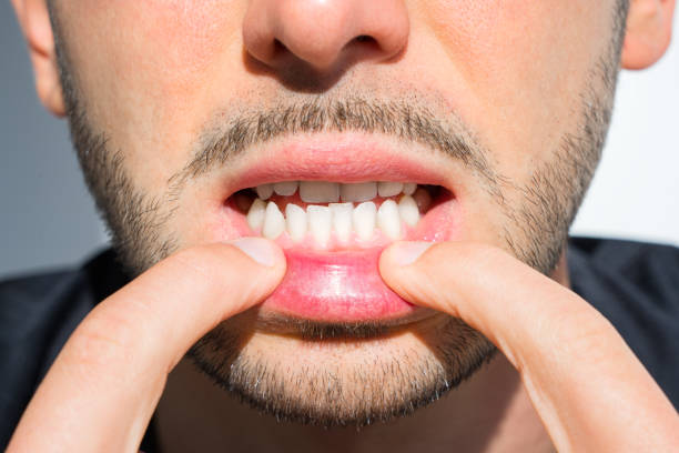 istock Young man crooked teeth. Reason to install teeth braces. Bad teeth 1296760436