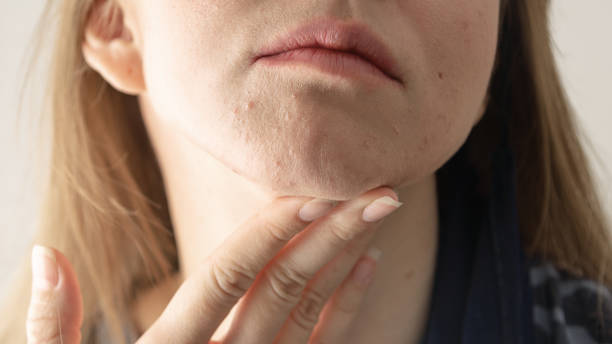istock Woman face with acne. 1296841136