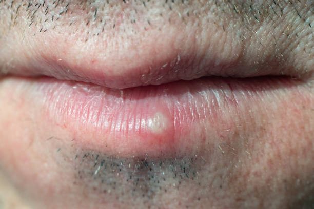 istock Herpes virus infection in a man on the lips 1296883053