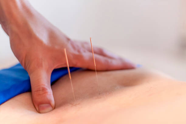 istock A man is being treated with acupuncture on his back. 1296884975
