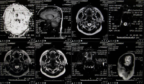 images de résonance magnétique du cerveau (cerveau d’irm). - crane shot photos et images de collection
