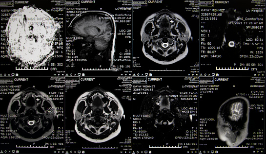 Human brain nervous system anatomy, medical diagram with parasympathetic and sympathetic nerves. medically accurate, skull cross section, Sebaceous bulb, 3d render