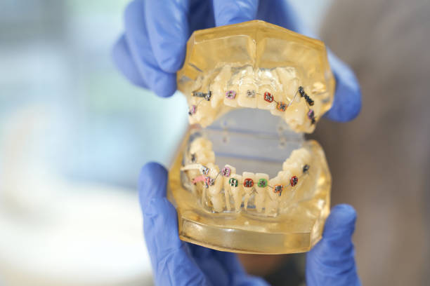 istock Dentist in gloves demonstrating braces system on teeth 1297018317