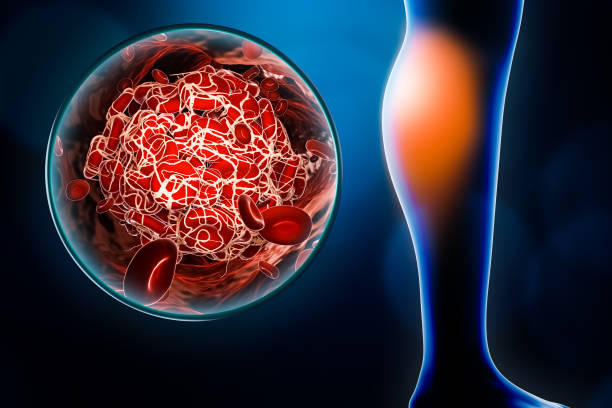 arterielle embolie oder embolie in der wade mit blutgerinnsel oder thrombus bild 3d rendering illustration. medizin, gesundheitszustand, gesundheit, krankheit oder gefäßpathologie konzepte. - blutgerinnsel stock-fotos und bilder