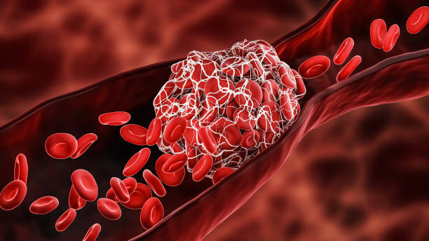 clot de sangre o trombo bloqueando el torrente de glóbulos rojos dentro de una arteria o una ilustración de representación 3d de vena. trombosis, sistema cardiovascular, medicina, biología, salud, anatomía, conceptos de patología. - coágulo de sangre fotografías e imágenes de stock