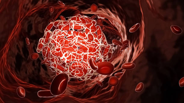 istock Thrombus or blood clot inside a blood vessel flowing with red blood cell 3D rendering illustration. Thrombosis, cardiovascular disease, medicine, pathology, science concepts. 1297034521