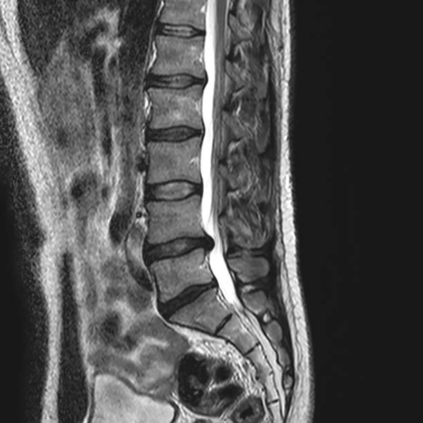 immagine di risonanza magnetica - vertebre della colonna vertebrale con un disco erniato che preme sul midollo spinale - disc break foto e immagini stock