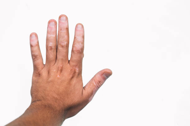 istock Hand with vitiligo on a white background 1297057774