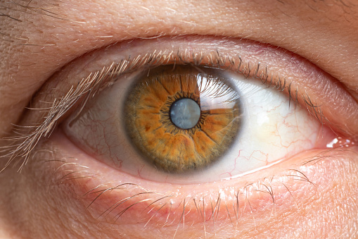 Fotos macro del ojo humano - opacidad de cataratas de la lente, deterioro de la visión. Tratamiento, cirugía y oftalmología photo
