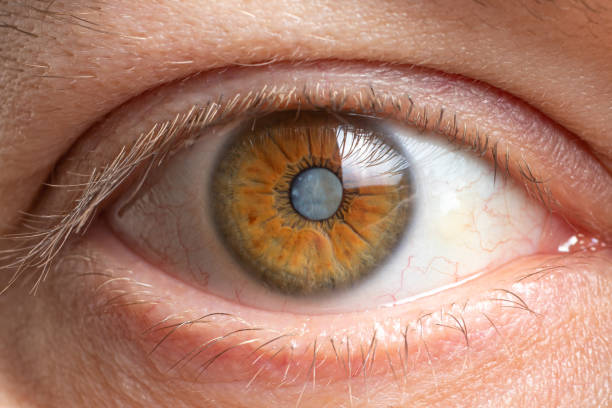 fotos macro del ojo humano - opacidad de cataratas de la lente, deterioro de la visión. tratamiento, cirugía y oftalmología - catarata fotografías e imágenes de stock