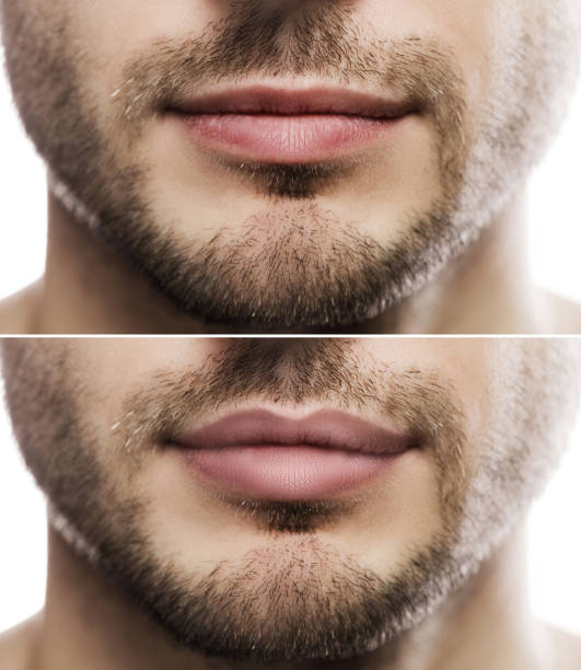 istock Lip augmentation. Male lips  before and after filler injection. 1297208435