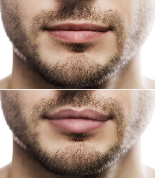 Lip augmentation. Male lips  before and after filler injection. Result of lip augmentation. Male lips  before and after filler injection. aesthetician photos stock pictures, royalty-free photos & images