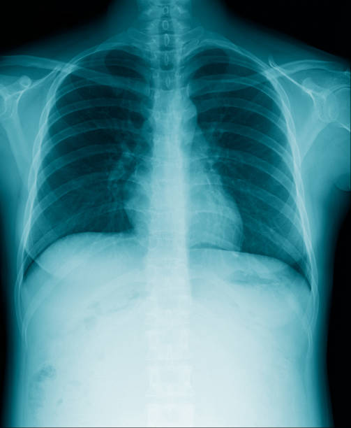 istock chest x-ray image in blue tone black background, lung infection with secretion 1297237093