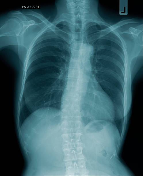 istock chest x-ray image in blue tone black background, lung infection with secretion 1297237116