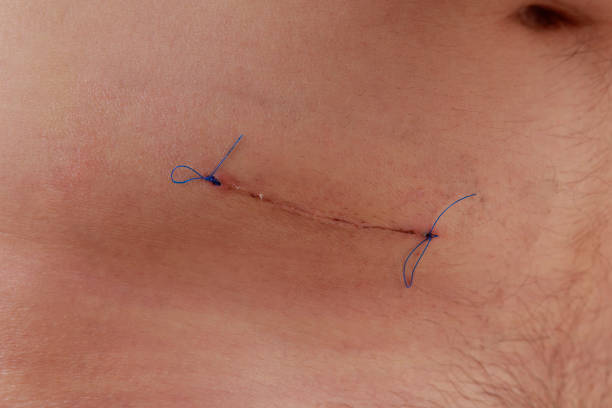istock male abdomen with appendicitis wound 1297247968