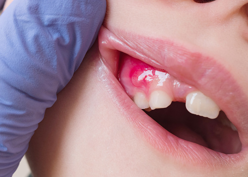 Absceso doloroso de hinchazón llena de pus en la encía de la boca en un niño de 8 años. photo