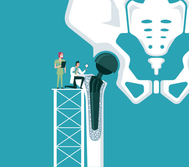 Structure of the artificial hip joint structure of the artificial hip joint, vector illustration hip replacement stock illustrations