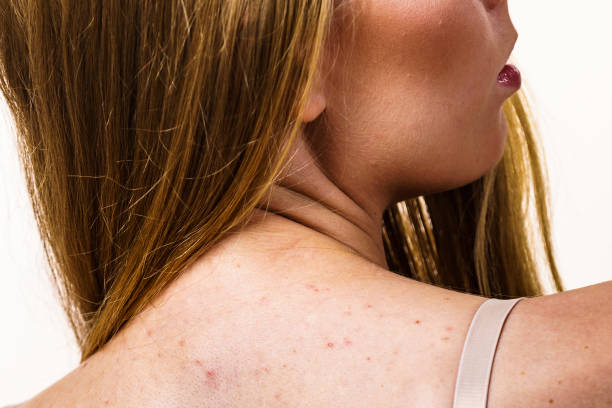 Woman with skin problem acne on back Health problem, skin diseases. Young woman showing her back with acne, red spots. Teen girl with many pimples. human back stock pictures, royalty-free photos & images