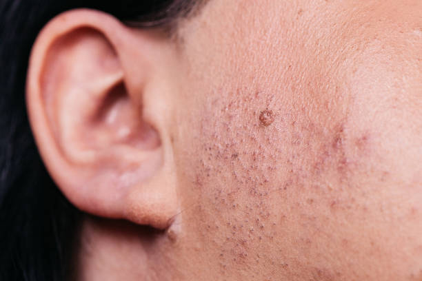 istock Skin face after removing hair 1297374826