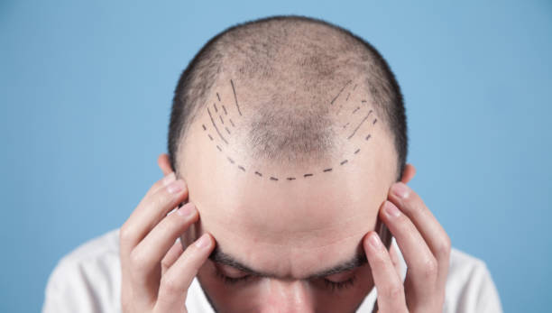 Caucasian bald man. Before hair transplantation Caucasian bald man. Before hair transplantation hair transplant stock pictures, royalty-free photos & images