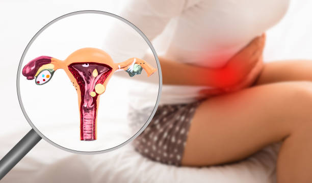 Endometriosis, virtual model of the uterus, close-up. Woman suffering from menstrual pain, while sitting on bed. Stomach pain Endometriosis, virtual model of the uterus, close-up. Woman suffering from menstrual pain, while sitting on bed. Stomach pain endometriosis stock pictures, royalty-free photos & images