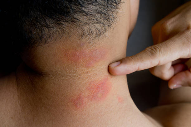primer plano de picaduras de insectos visibles en el cuello adulto. piel irritada. - asnillo fotografías e imágenes de stock