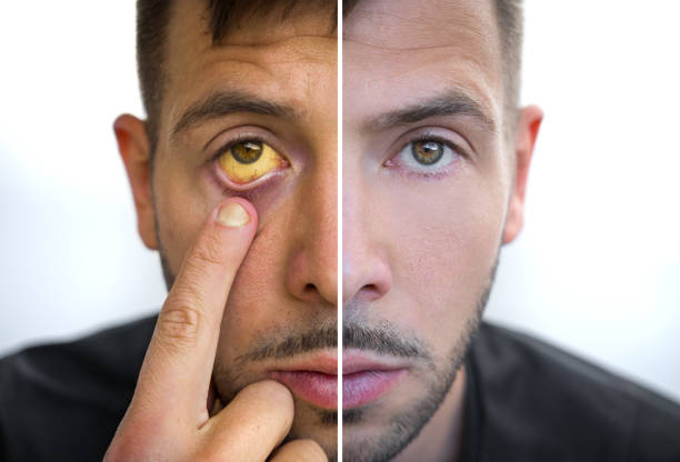 Man face divided into two parts one healthy and one unhealthy. Yellowish eyes and skin. Bad habits vs good habits. Jaundice, hepatitis, cirrhosis, liver failure. Risk factors of alcohol drinking Man face divided into two parts one healthy and one unhealthy. Yellowish eyes and skin. Bad habits vs good habits. Jaundice, liver failure. Risk factors of alcohol drinking. High quality photo liver failure stock pictures, royalty-free photos & images