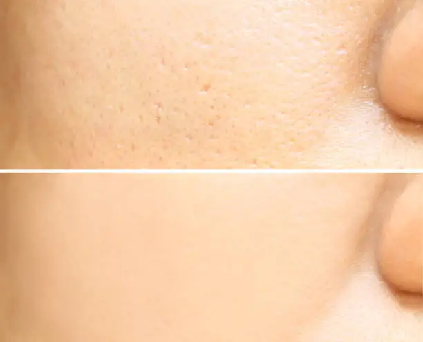 Compare before and after (retouch photo) of close up wide large pores skin on oily face have pimple of asia woman effect after use cream or treatment for facial care face skin to better