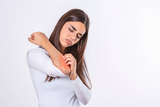 Young woman scratching her itchy arm. Skin problems and allergy. Healthcare and medical concept. Young woman scratching her itchy arm. Skin problems and allergy. Healthcare and medical concept. bug bite photos stock pictures, royalty-free photos & images
