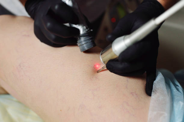 removal of rosacea or vascular mesh on the patient's legs with a neodymium laser. stock photo