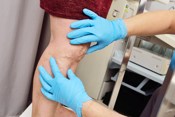 phlebologist or vascular surgeon examines the varicose veins of the lower extremities of a patient in a modern dermatological clinic. - coágulo imagens e fotografias de stock