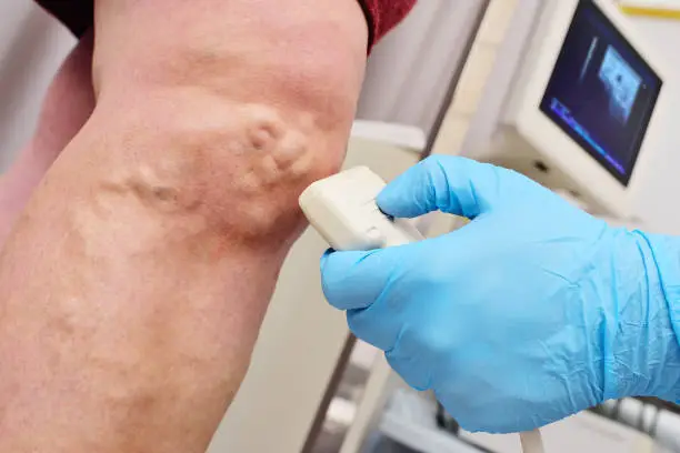 Photo of A phlebologist or vascular surgeon performs an ultrasound examination of the patient's veins.