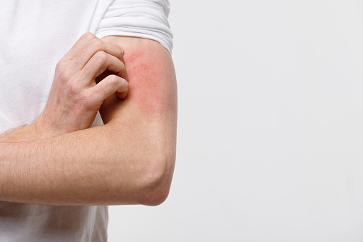 Close up of male scratching the itch on his hand, isolated on grey background, copy space. Pruritus, animal/food/cosmetic allergy, dermatitis, insect bites, irritation concept.