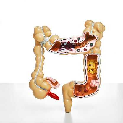 Colon model with pathologies, and different diseases, close-up for medical and biological education