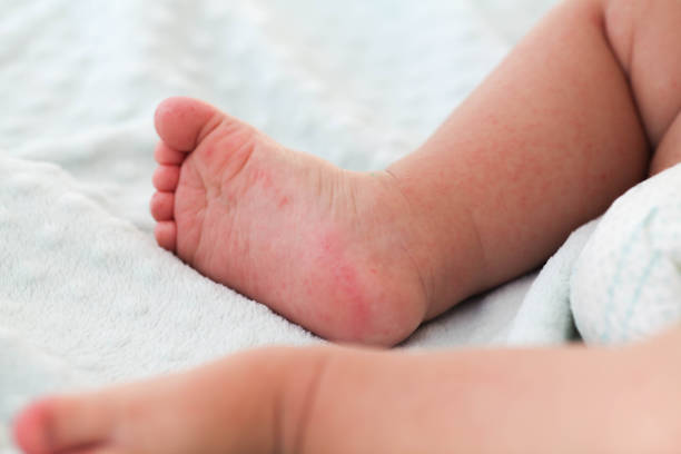 un petit enfant avec une éruption rouge sur la jambe s’assied sur le bâti. les enfants sont des allergies. entérovirus. - chickenpox skin condition baby illness photos et images de collection