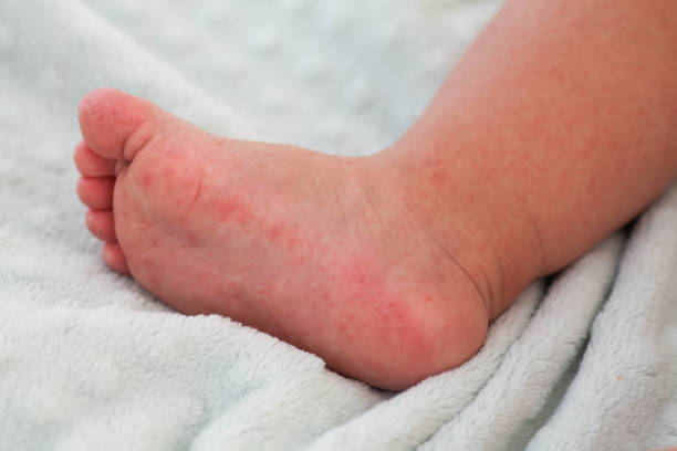 다리에 빨간 발진이 있는 어린 아이가 침대에 앉아 있습니다. 아이들은 알레르기입니다. 엔테로바이러스. - chickenpox skin condition baby illness 뉴스 사진 이미지