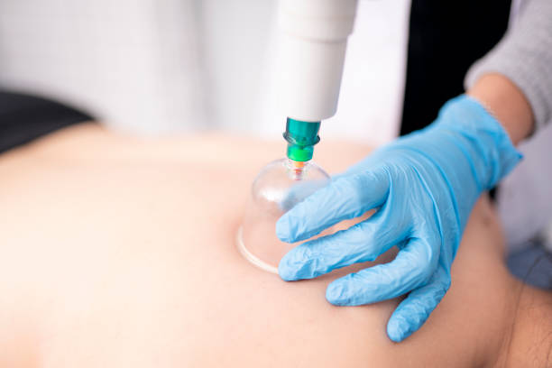 Female physiotherapist is examining to her patient. Physiotherapist applying acupuncture therapy. She is placing cup on the back of a female patient. cupping therapy stock pictures, royalty-free photos & images