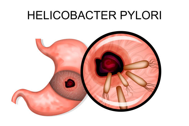 ilustraciones, imágenes clip art, dibujos animados e iconos de stock de patología del estómago. helicobacter pylori - pylori