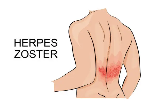Vector illustration of human infection herpes zoster