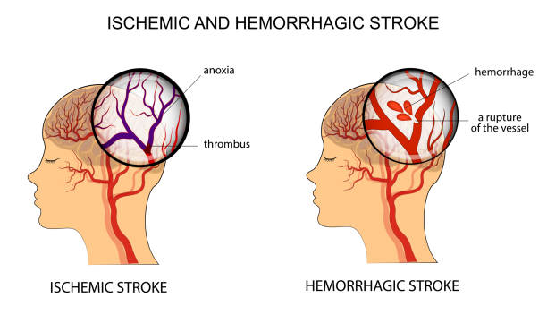 ISCHEMIC AND HEMORRHAGIC STROKE vector illustration of the vessels of the brain and a brief description of the causes of stroke anoxia stock illustrations