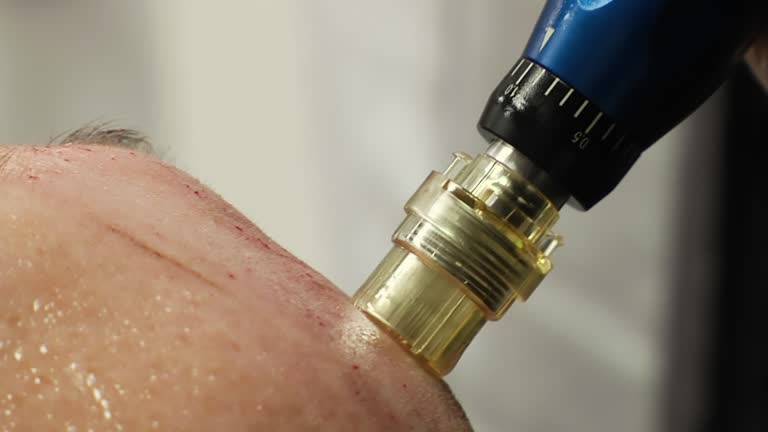 Close-up of Collagen Induction Therapy Procedure