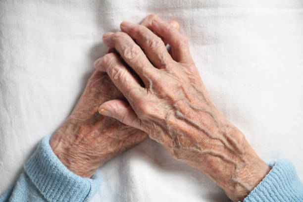 rheumatoid arthritis of the hands of an elderly 90 year old woman on a white background. - 80 year old imagens e fotografias de stock