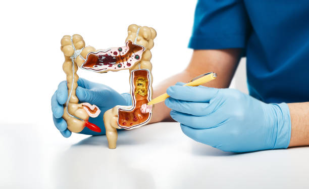 krebsdarm. gastroenterologe zeigt pen-tumor-kolon mit einem anatomischen modell für die medizinische ausbildung - gastroenterologe stock-fotos und bilder