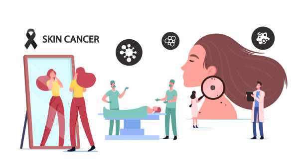 Skin Cancer Concept. Tiny Doctor Oncologist Character Examine Woman Moles with Huge Magnifier. Surgeon Make Operation Skin Cancer Concept. Tiny Doctor Oncologist Character Examine Woman Moles with Huge Magnifier. Surgeon Make Operation in Hospital. Girl Searching Birthmarks on Face. Cartoon People Vector Illustration melanoma stock illustrations